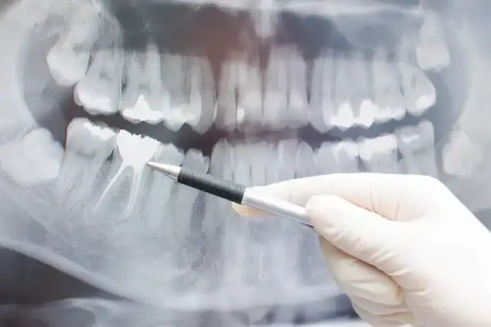 Dental X-ray with a tool pointing at teeth.