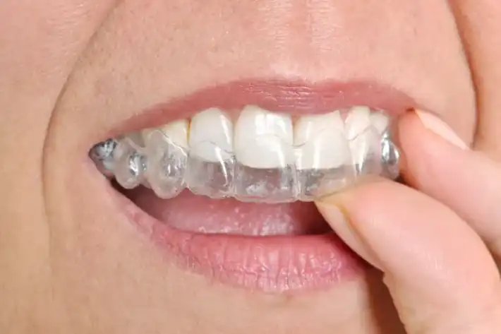 A person inserting a clear dental aligner over their teeth.