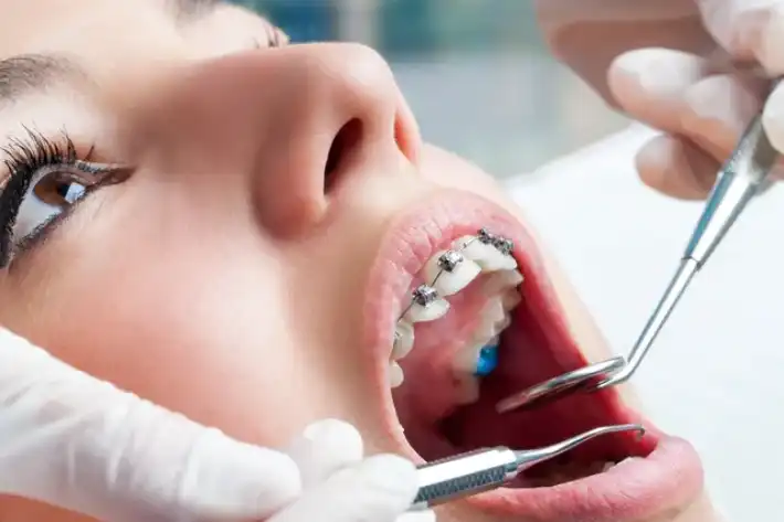 Close-up of dental braces being adjusted in a patient's mouth.