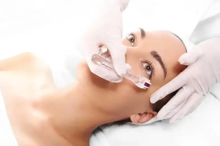 Woman receiving a facial microneedling treatment at a spa.