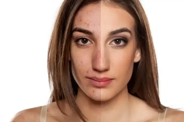 Split-face portrait showing one side with clear skin and the other with blemishes.